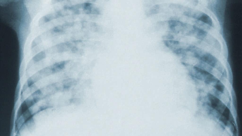 lungs x ray